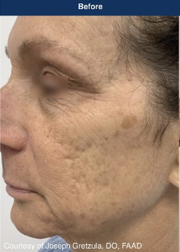 UltraClear Laser Before & After