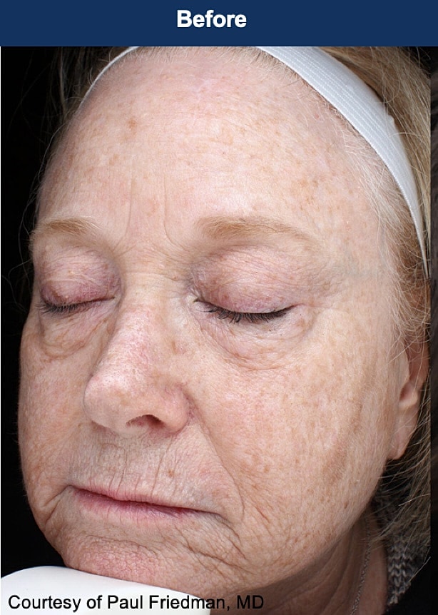 UltraClear Laser Before & After