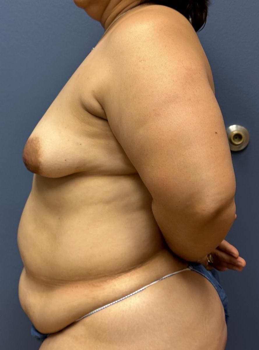 Tummy Tuck Before & After