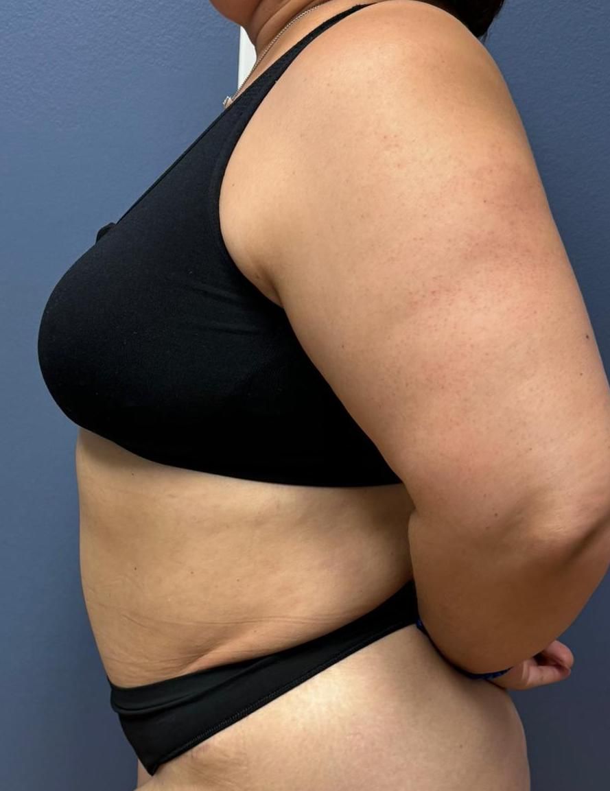 Tummy Tuck Before & After