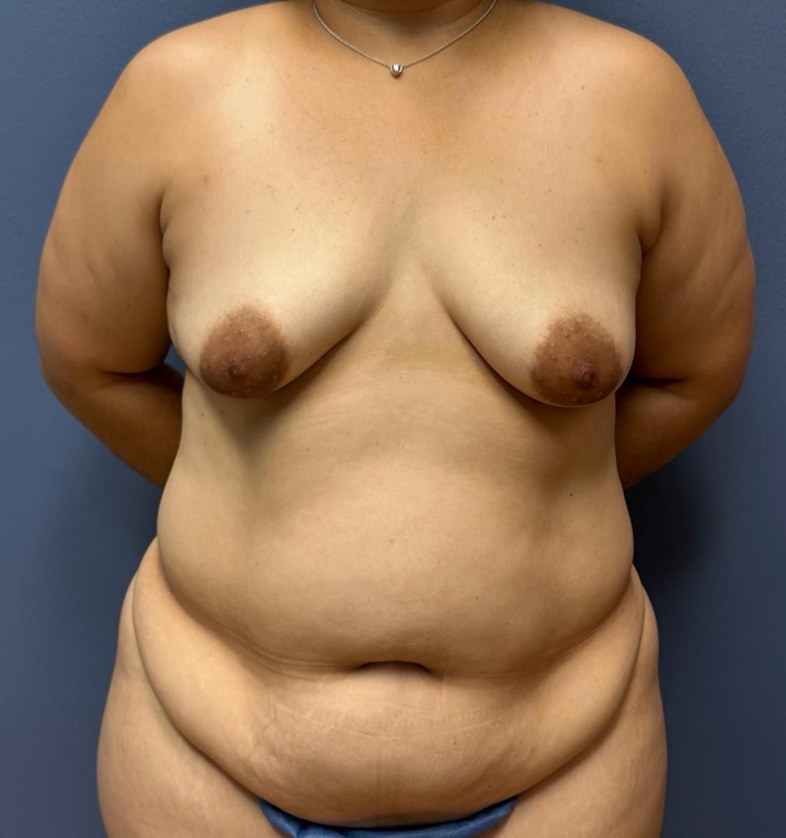 Tummy Tuck Before & After