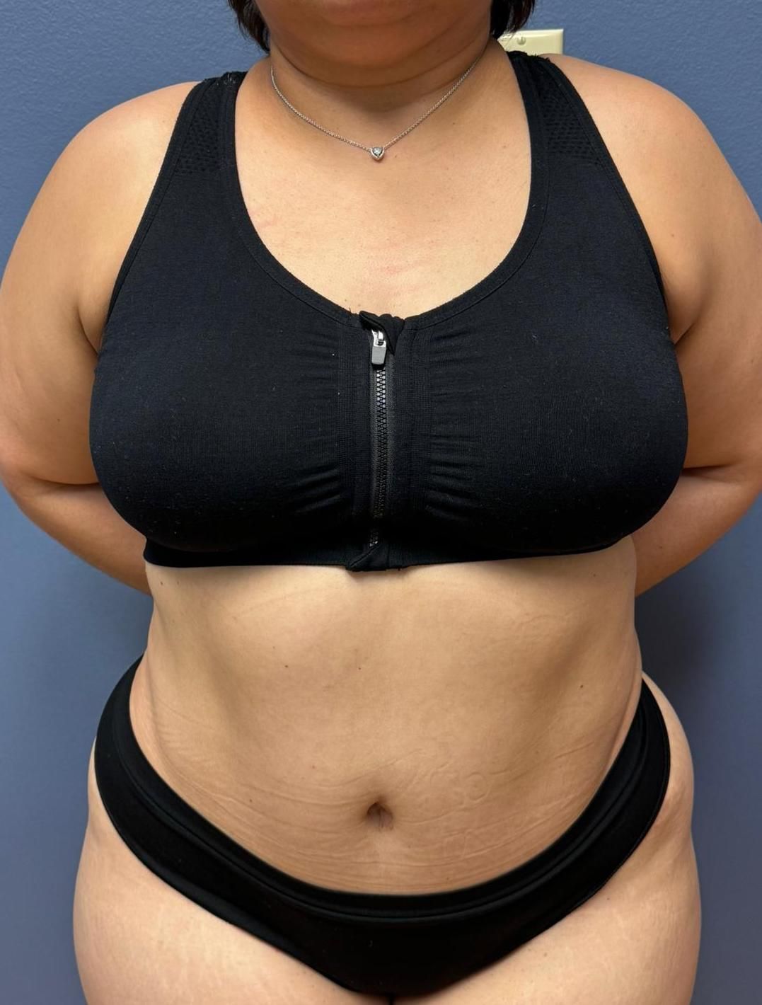 Tummy Tuck Before & After