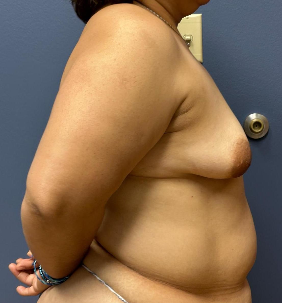 Tummy Tuck Before & After