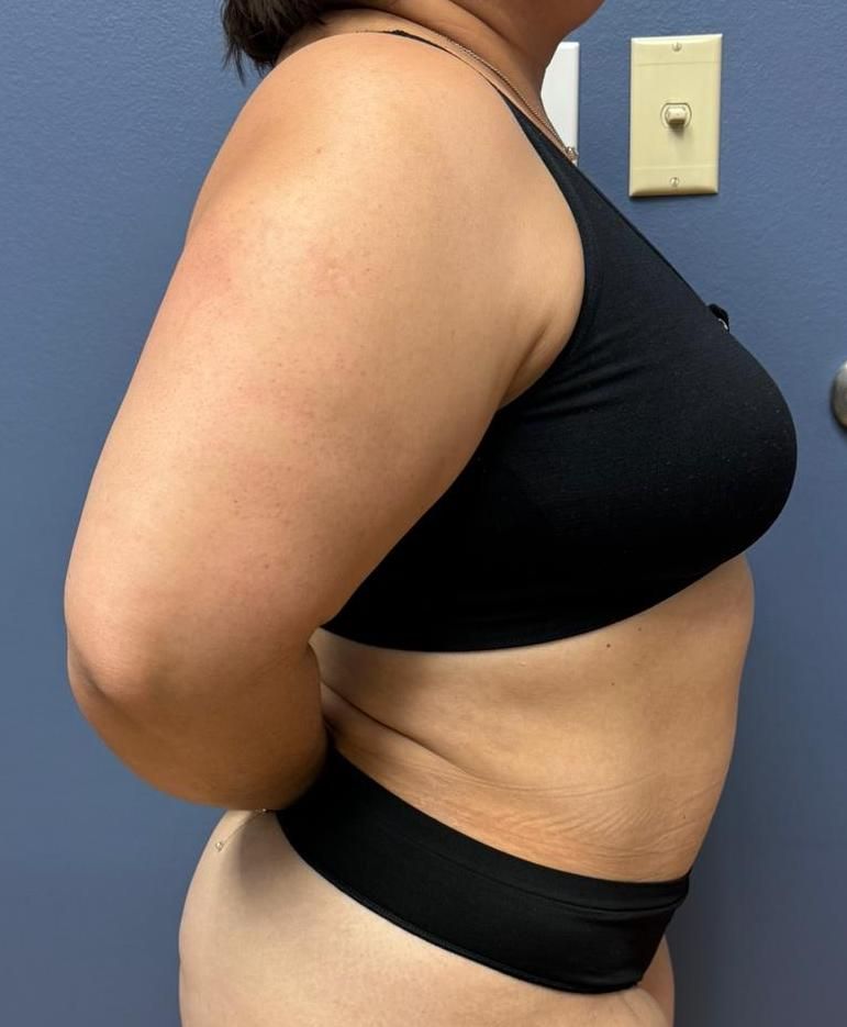 Tummy Tuck Before & After