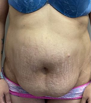 Tummy Tuck Before & After