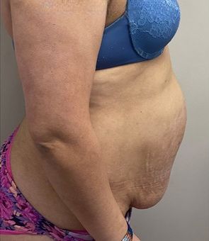 Tummy Tuck Before & After