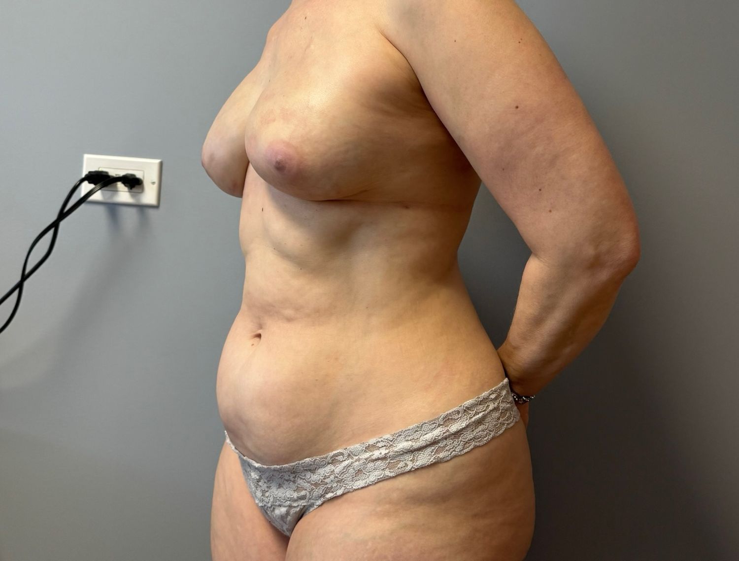 Tummy Tuck Before & After