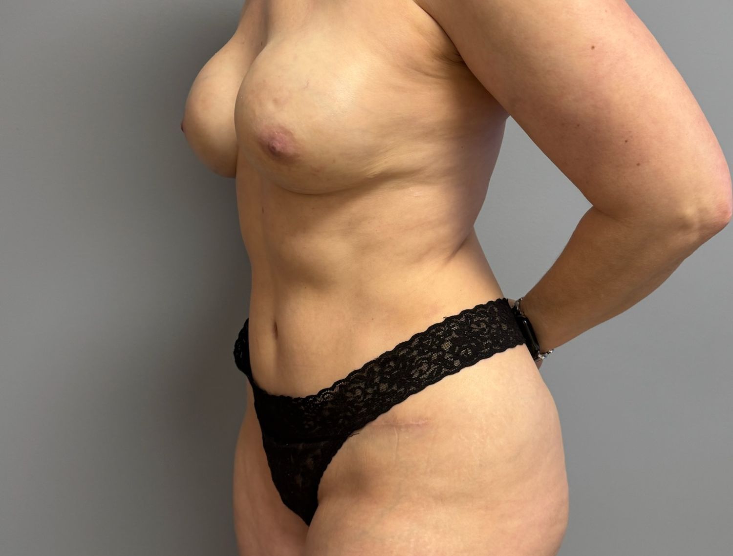 Tummy Tuck Before & After