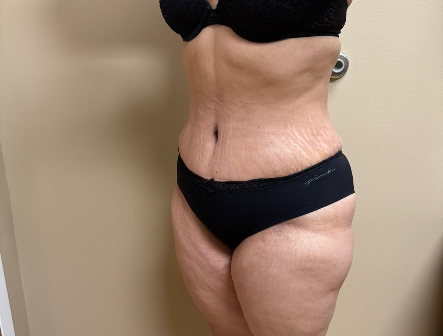 Tummy Tuck Before & After