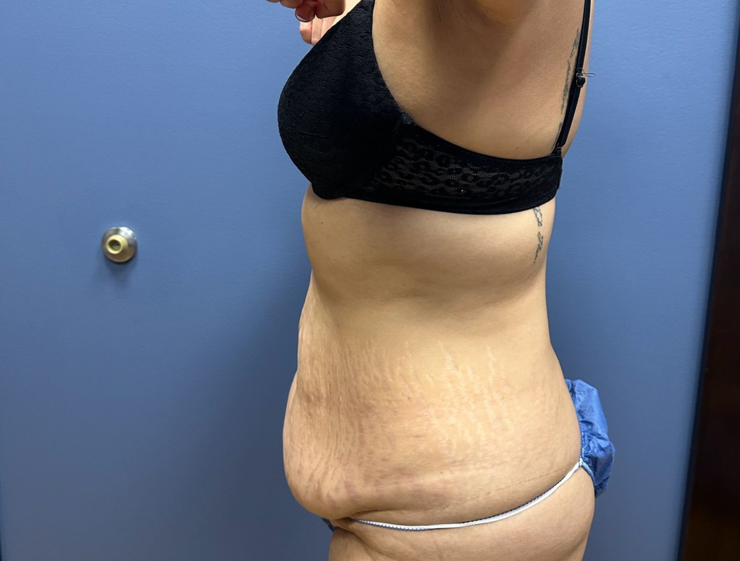 Tummy Tuck Before & After