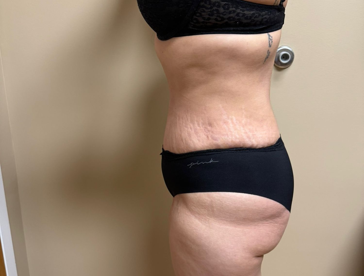 Tummy Tuck Before & After