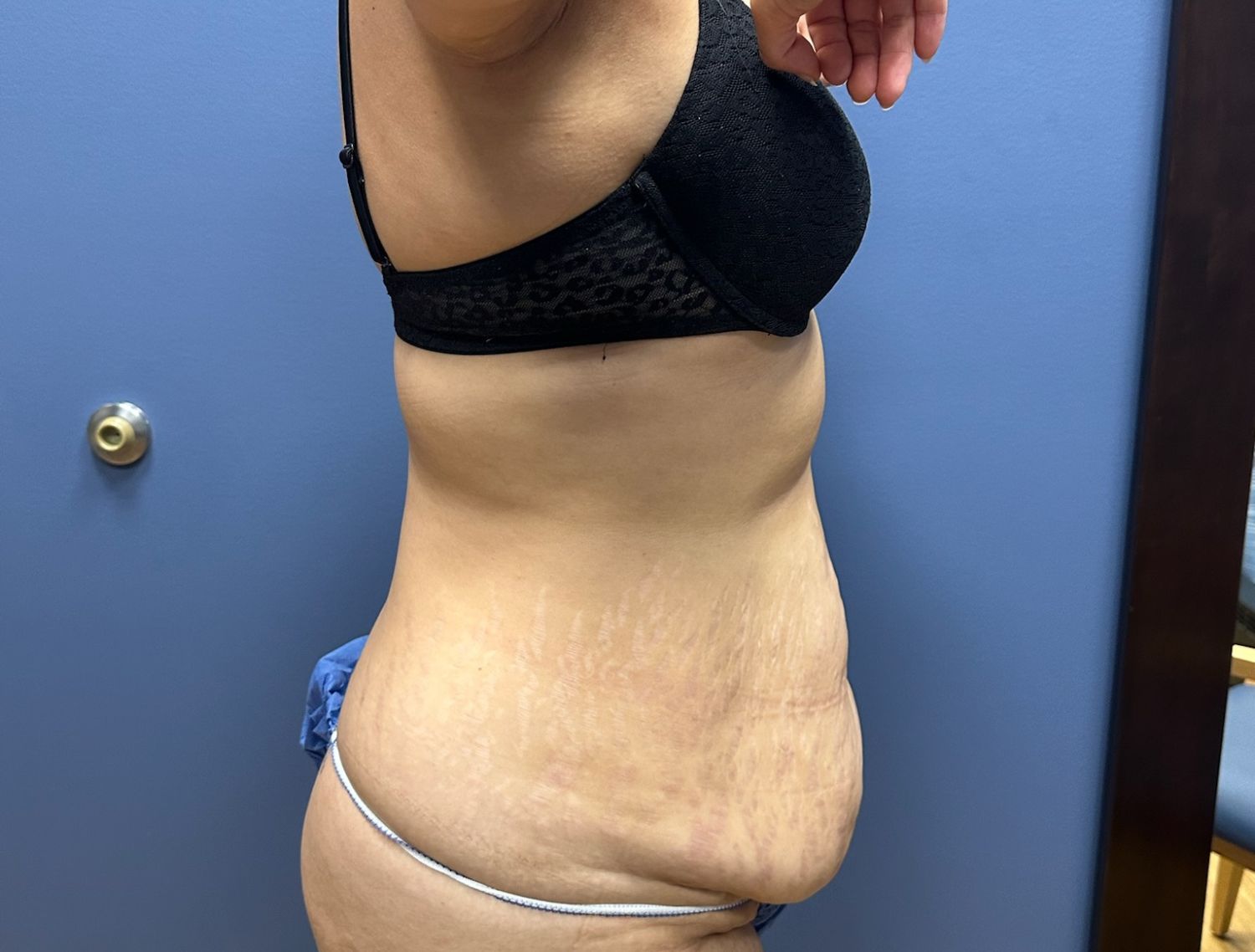 Tummy Tuck Before & After