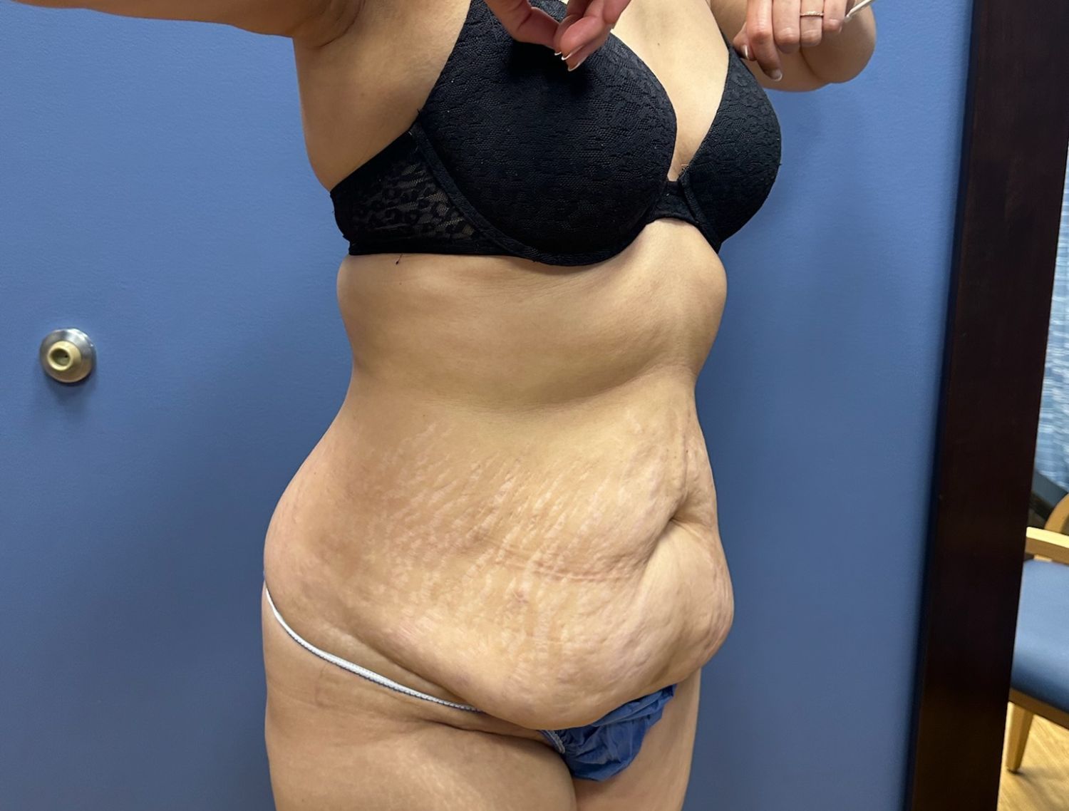 Tummy Tuck Before & After