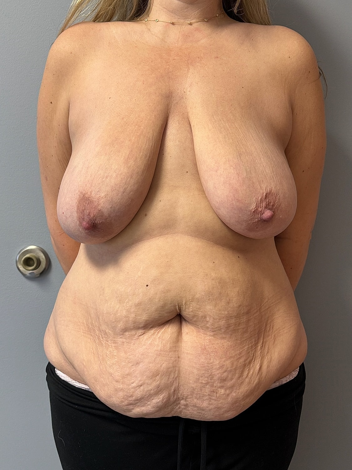 Breast Lift Before & After
