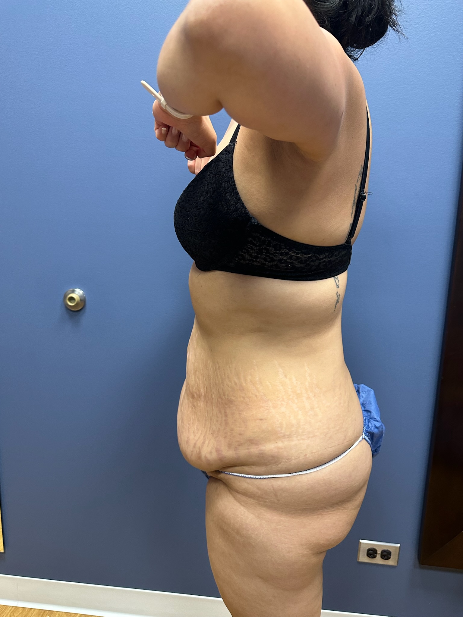 Abdominoplasty image, gallery 612