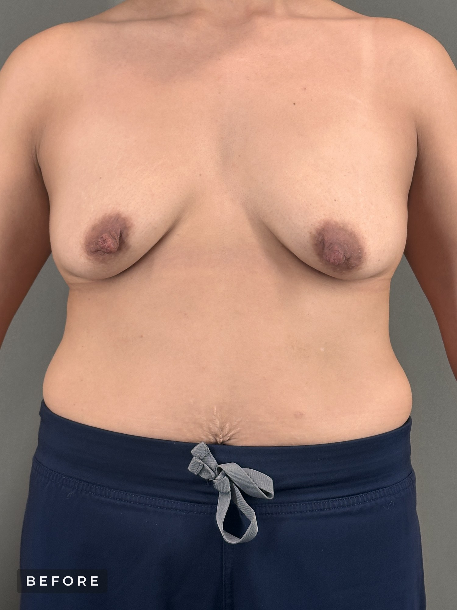 Motiva Preservé breast augmentation with breast lift image, gallery 437