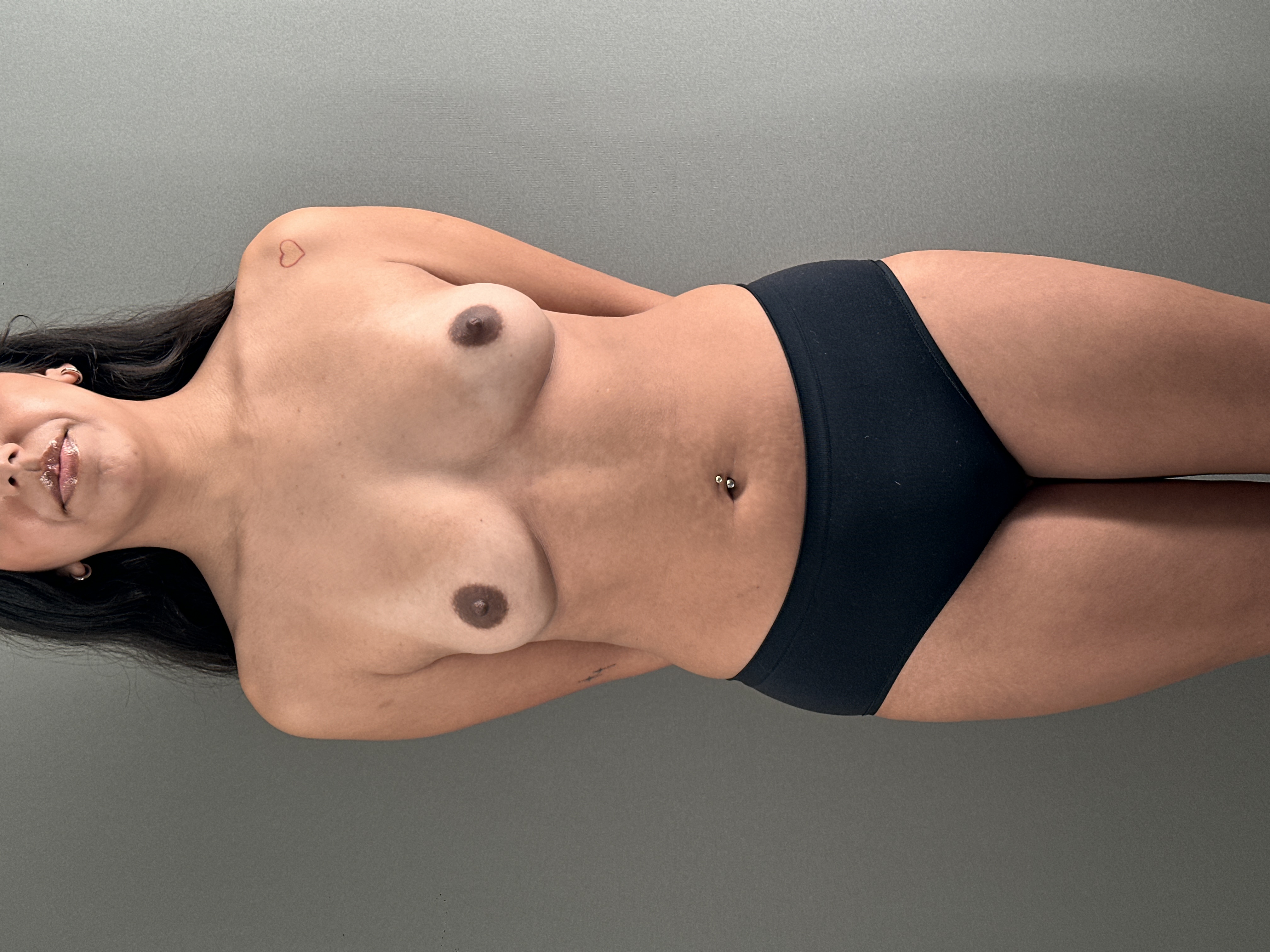 Motiva Preservé breast augmentation image, gallery 152
