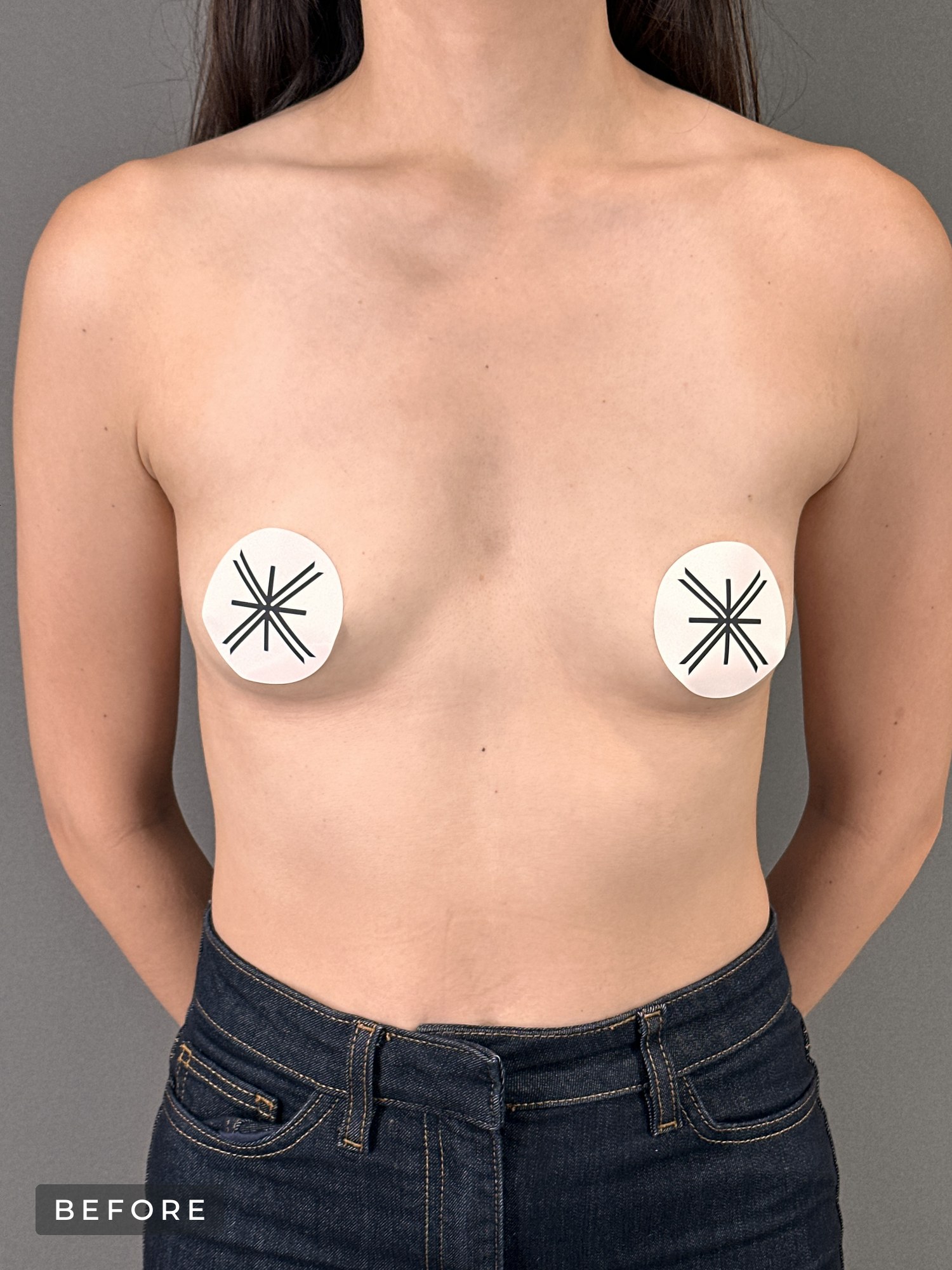 Motiva Preservé breast augmentation image, gallery 562